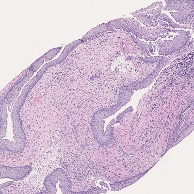 G)  Multiple Lower Urinary Tract Biopsies