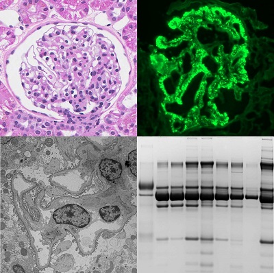 C)  Comprehensive Renal Biopsy (LM, TEM, IF, +/- SDS-PAGE)