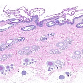 A)  Dermatopathology Report: histology, diagnosis and comments